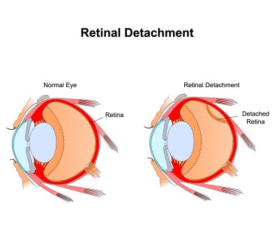 retinal conditions